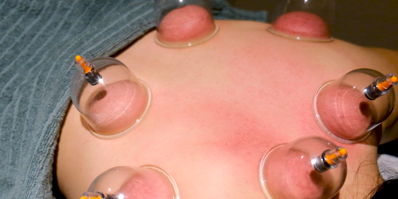 TCM Cupping therapy. Glass cup being placed on the skin, creating suction to promote circulation and alleviate tension, effective for pain relief and wellness
