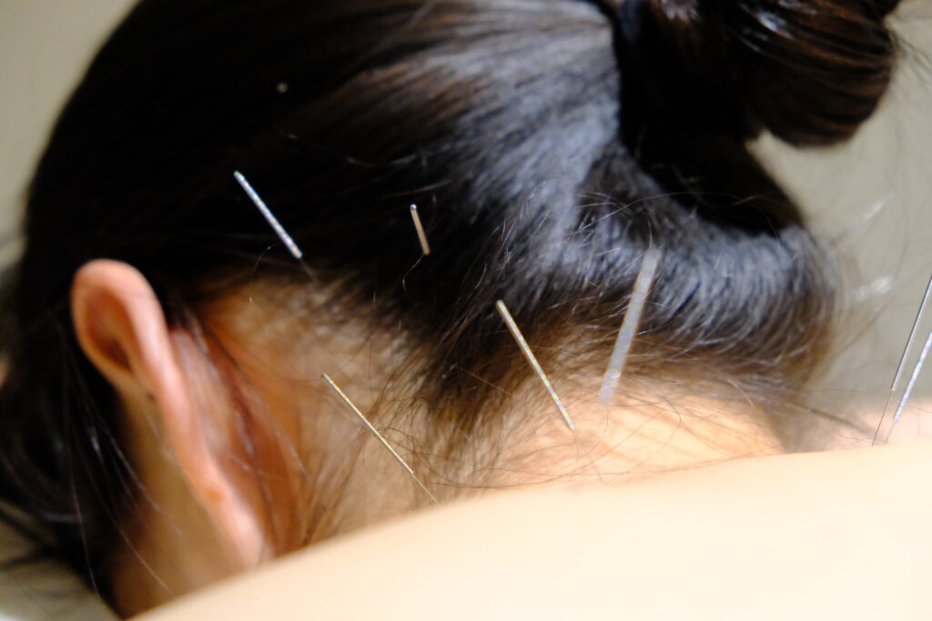 TCM treatments - acupuncture, cupping, gua sha, moxibustion for neck pain such as Stiff Neck, Whiplash & Cervical Pain, and more