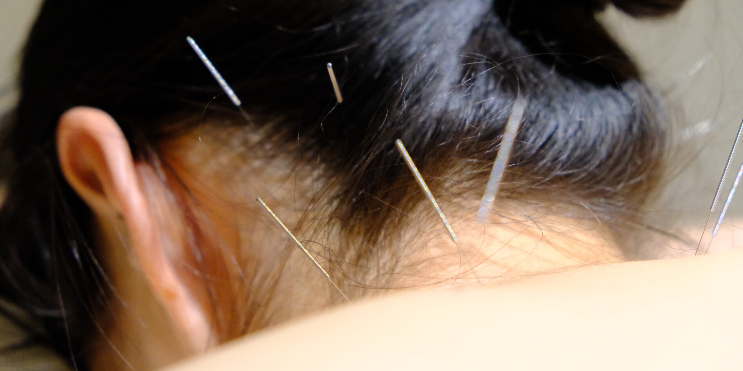 TCM treatments - acupuncture, cupping, gua sha, moxibustion for neck pain such as Stiff Neck, Whiplash & Cervical Pain, and more