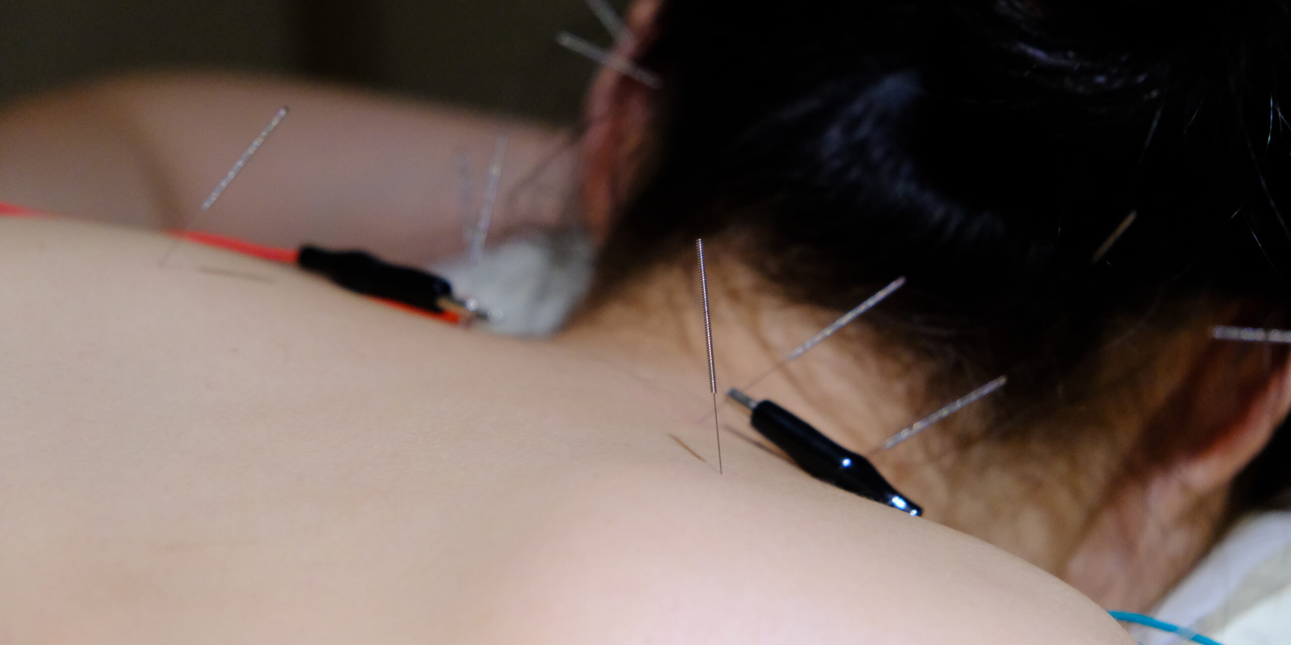 TCM treatments - acupuncture, cupping, gua sha, moxibustion for shoulder pain such as frozen shoulder, rotator cuff injury, tendinitis, and more