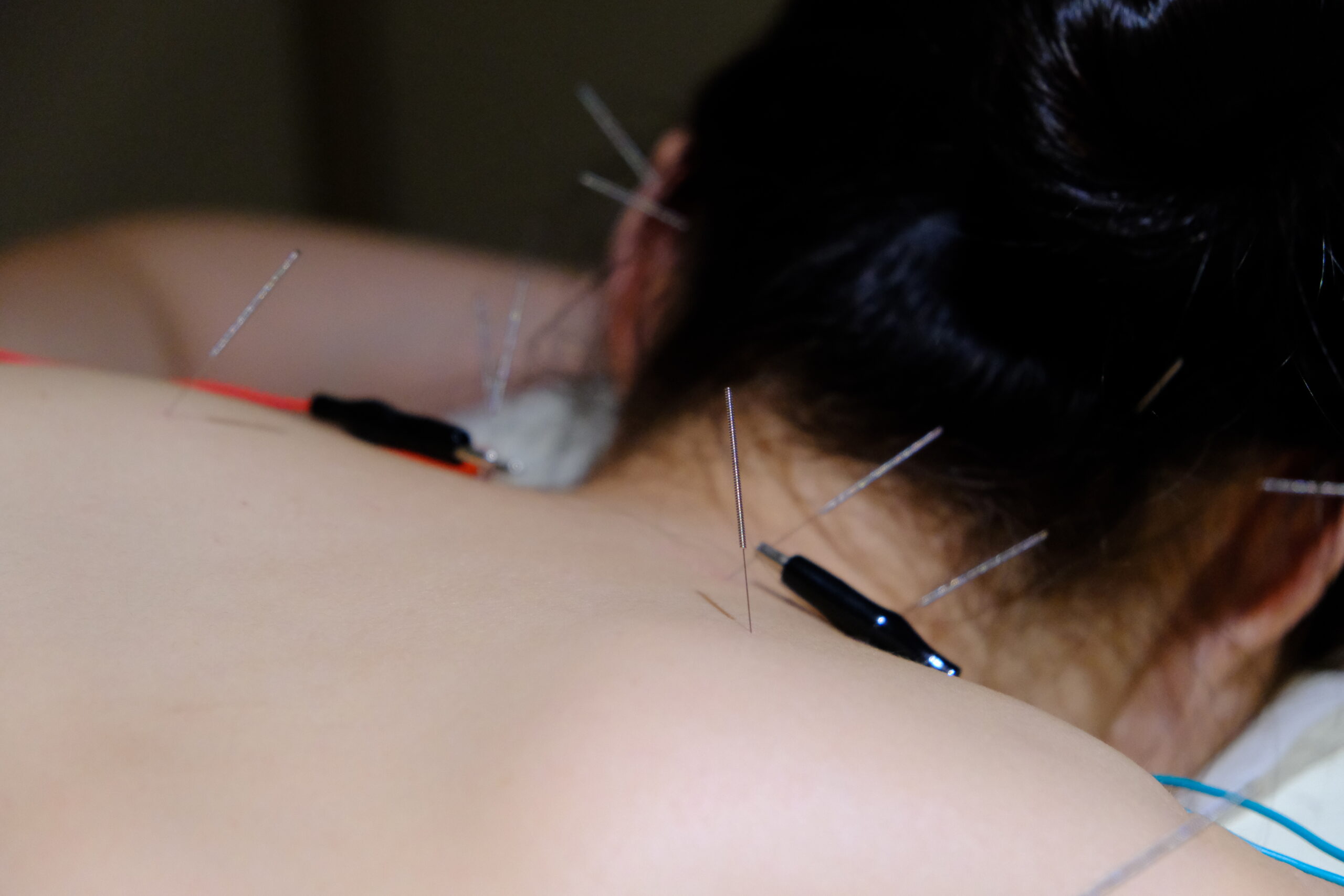 TCM treatments - acupuncture, cupping, gua sha, moxibustion for shoulder pain such as frozen shoulder, rotator cuff injury, tendinitis, and more