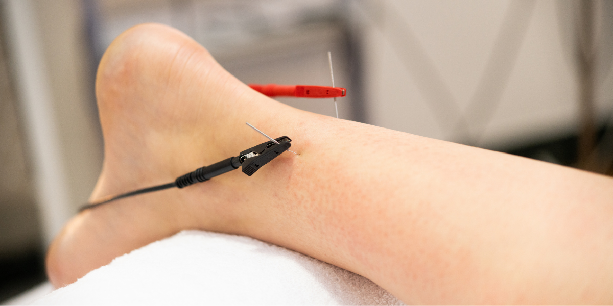 TCM treatments for ankle pain - acupuncture, cupping, gua sha, moxibustion for ankle pain such as sprained ankle, Achilles Tendinitis, Post-Repair Recovery for Achilles Rupture, and more